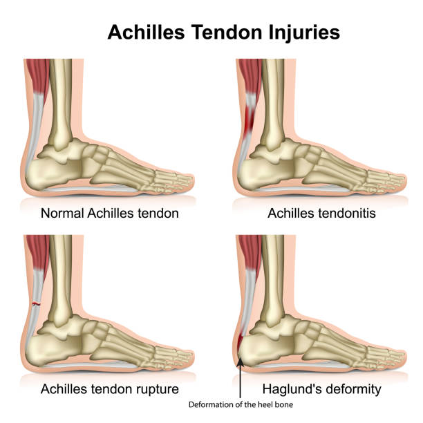 Achilles Tendonitis and Tendinopathy: What's the Difference? – MDUB ...